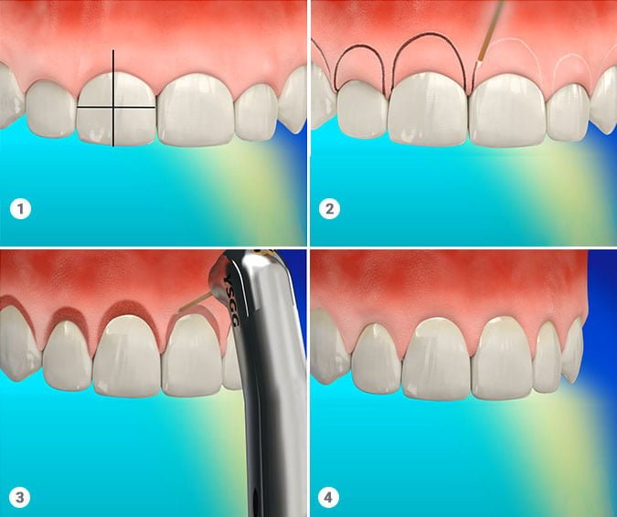 Dental Tooth Crown Procedure in New York, NY