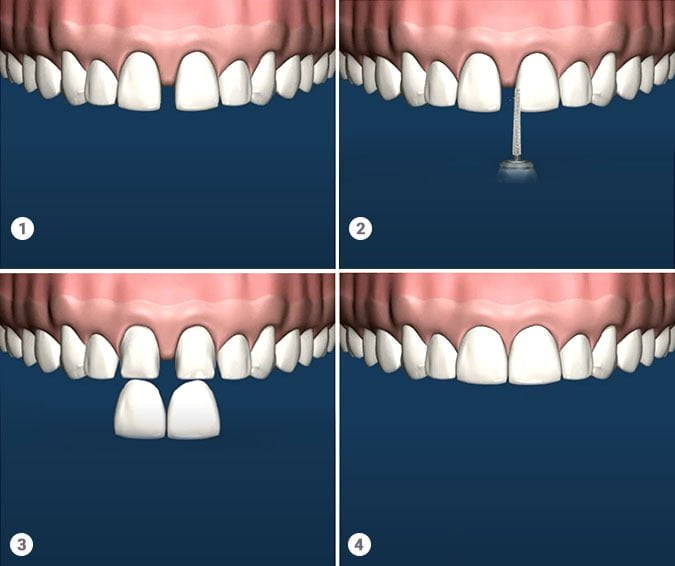 teeth veneers procedure