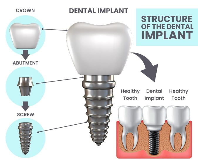 Who Can Benefit from Dental Implants? Shalman Dentistry