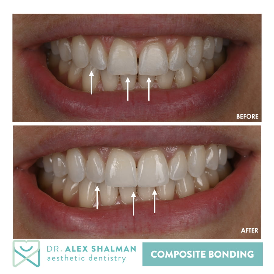 Clear Aligners